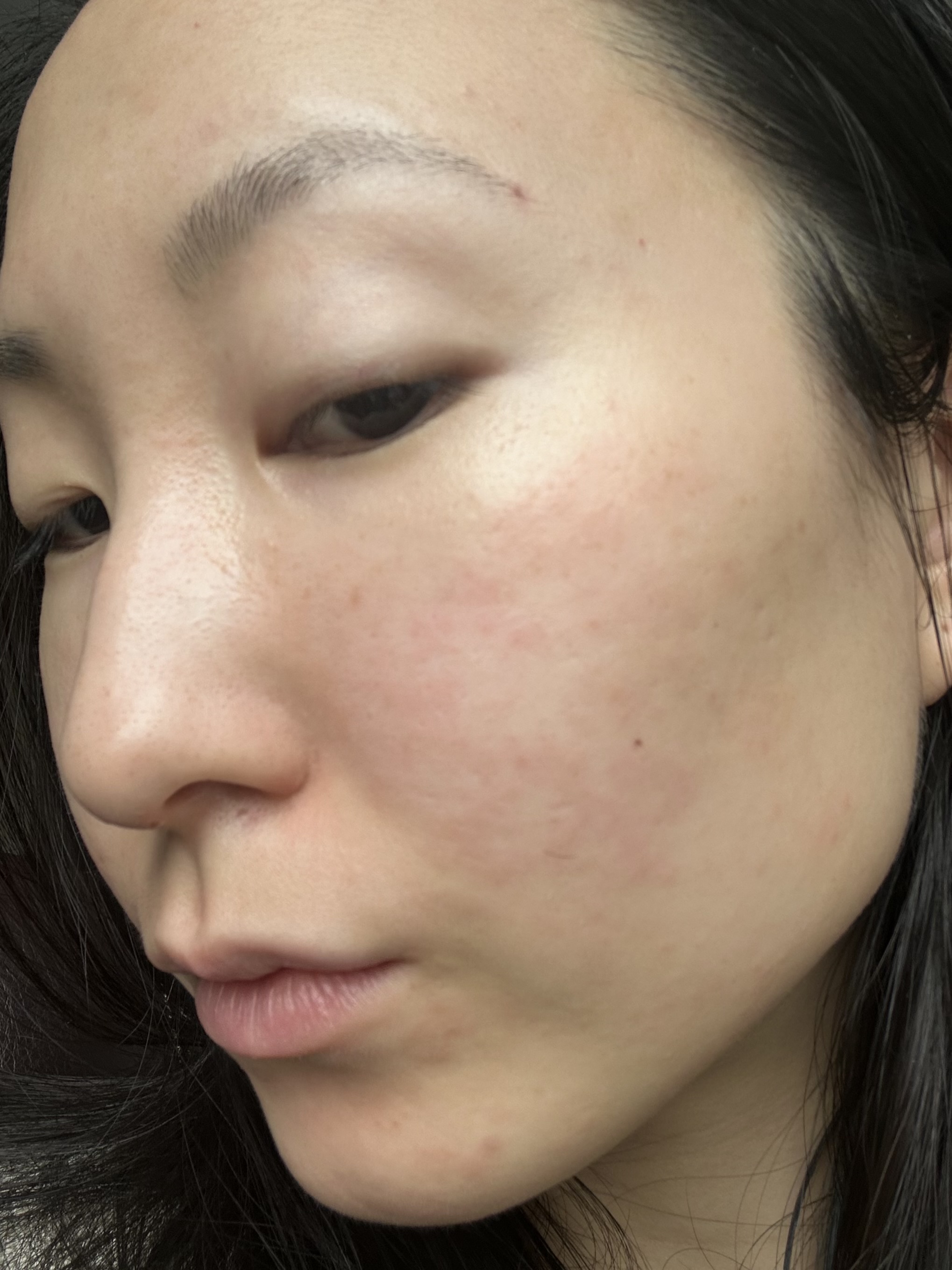 Eczema on face